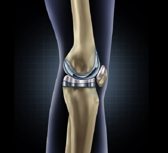 56997807 - knee replacement implant medical concept as a human leg anatomy after a prosthetic surgery as a musculoskeletal disease treatment symbol for orthopedics with 3d illustration elements.